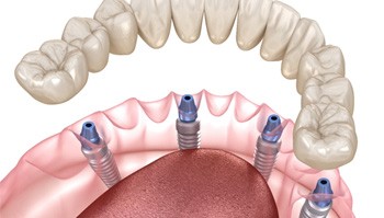 Digital illustration of all-on-4 dentures