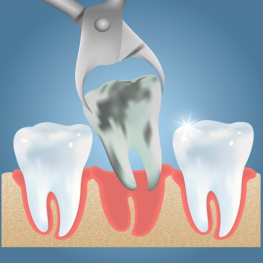 illustration of tooth extractions in Brick Township 