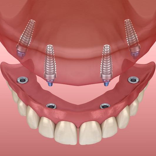 Implant dentures for upper arch viewed from above