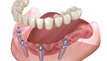 Illustration of lower implant denture