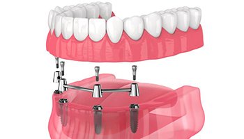 Bar-retained removable implant denture