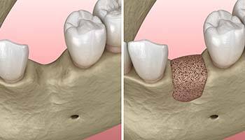 Digital comparison of bone grafting in Brick Township for dental implants