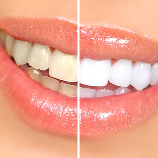 A before and after image of a person’s teeth after undergoing teeth whitening