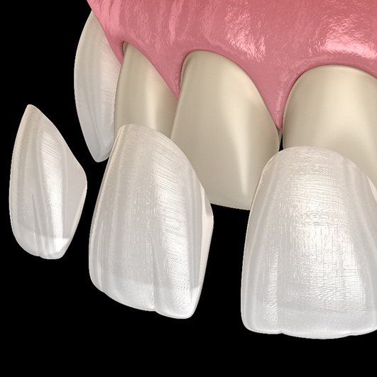 A digital image of veneers being placed onto the front surface of four teeth located on the upper arch