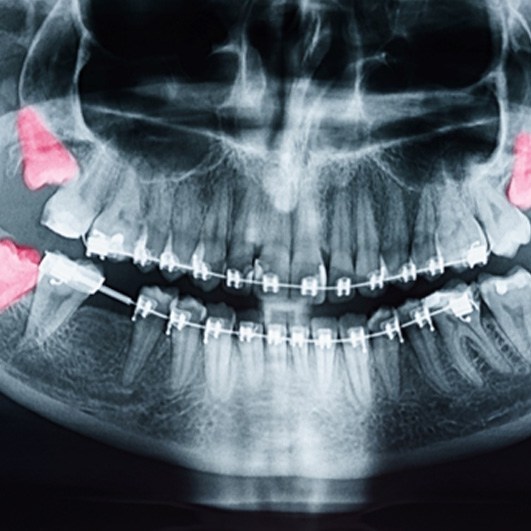 X-ray showing impacted wisdom teeth in Barnegat, NJ